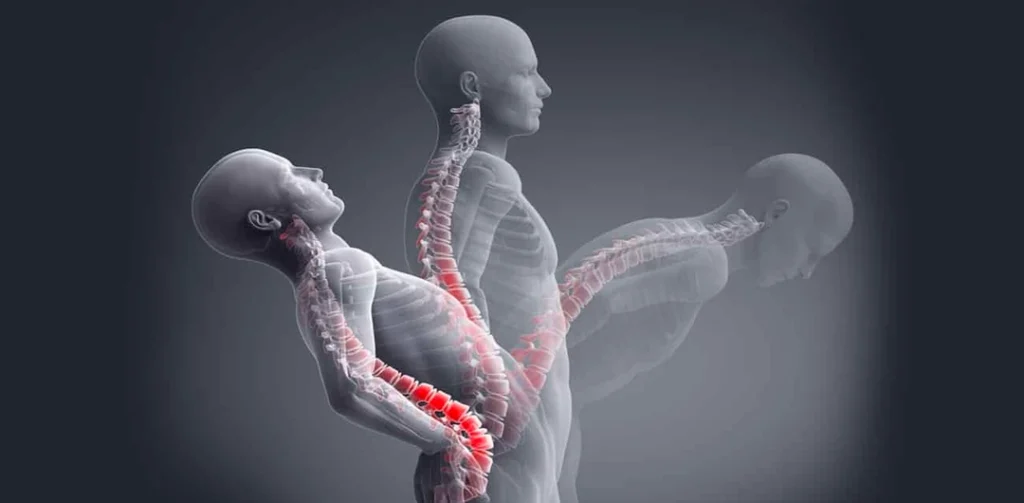 Ankilozan Spondilit: Tanım, Süreç ve Tedavi Yöntemleri