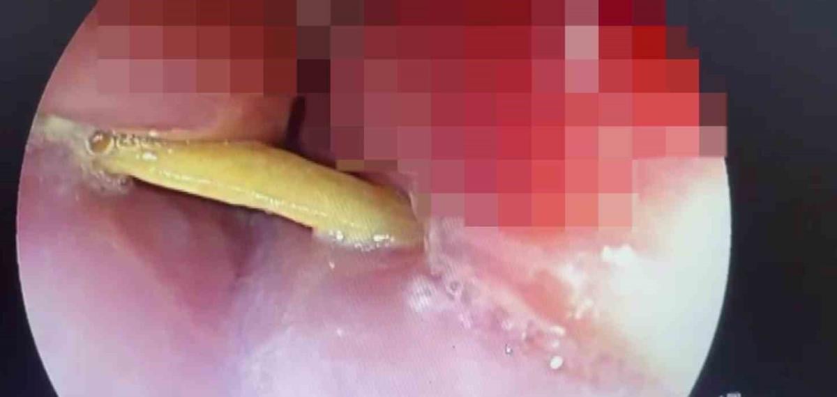 Boğazına Saplanan 5 Santimlik Kemik Öldürüyordu