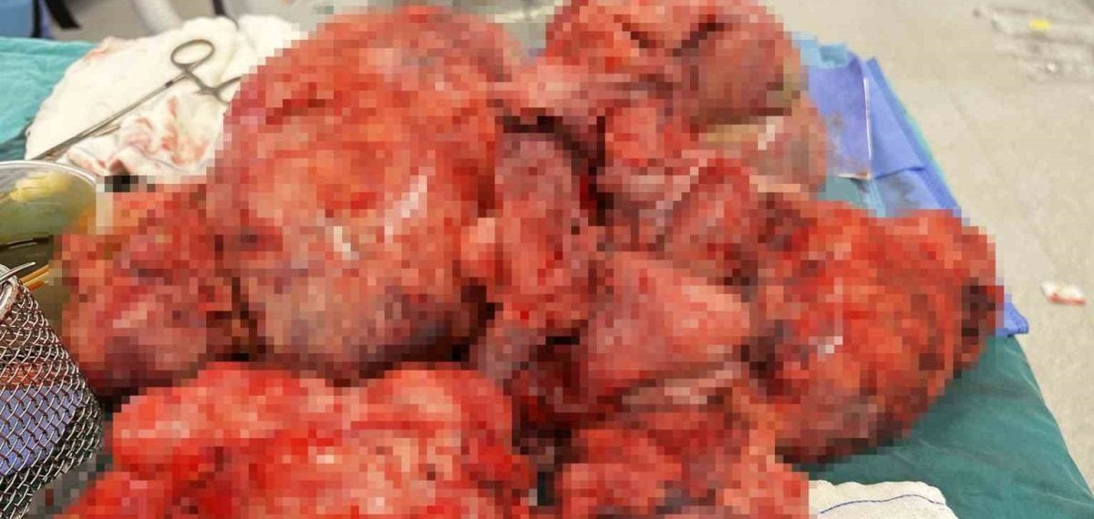 60 santimetre çapında 17 kilogramlık miyom rahim korunarak çıkarıldı