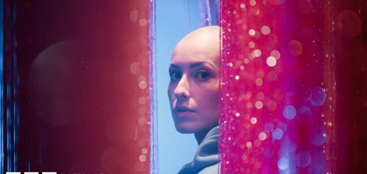 Actor Emily Glaze bares her alopecia story with one-woman show at Edinburgh Fringe
