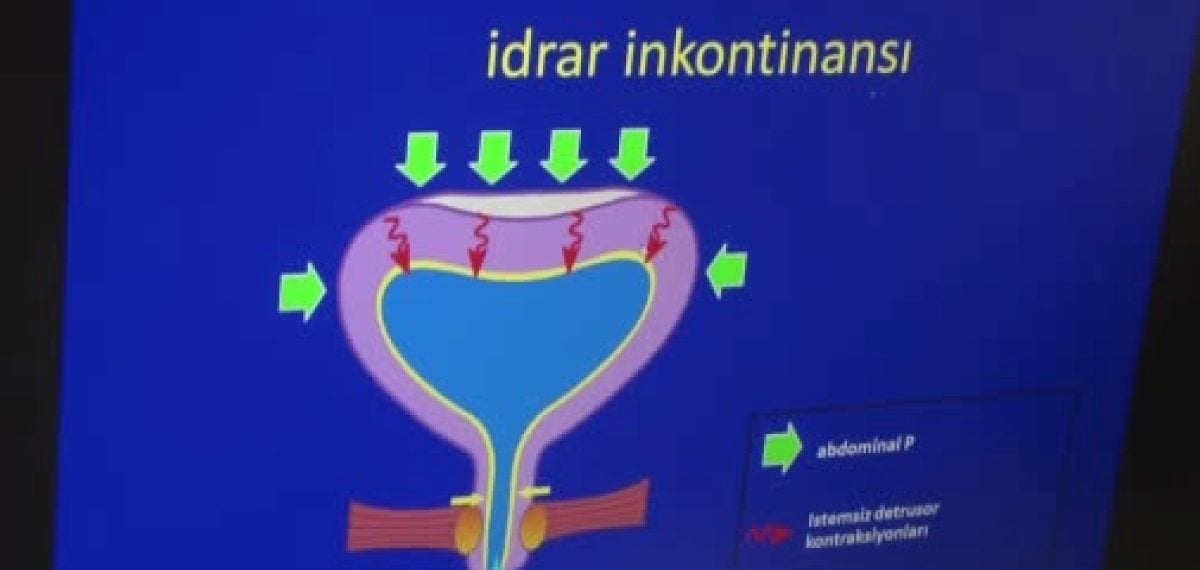 Kadınlarda sık görülen idrar kaçırma: nedenleri ve tedavi seçenekleri