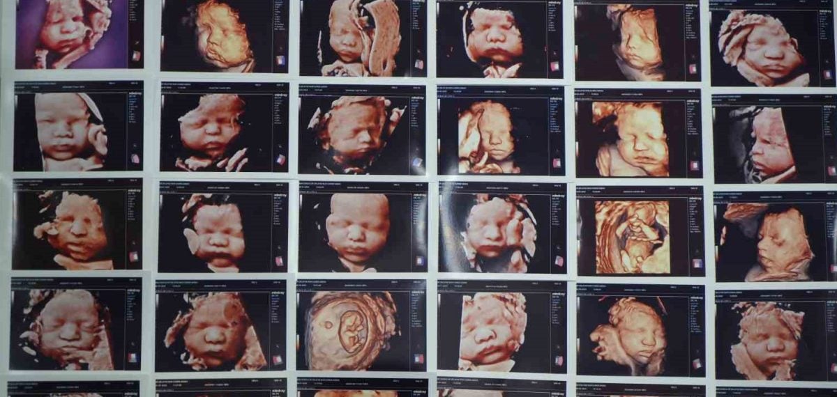 7 yıllık bebek hasreti sona erdi: Kişiye özel tüp bebekle 20 haftalık gebelik