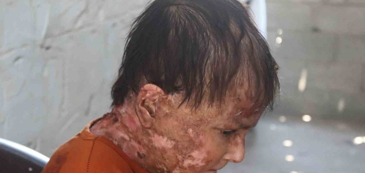 Gazze’de Epidermolysis Bullosa hastası Reema, acil tedavi için uluslararası tahliye çağrısı yaptı
