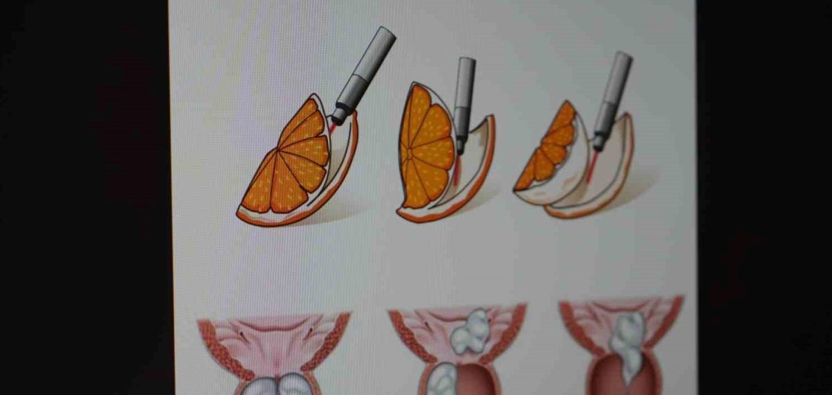 HoLEP lazer cerrahisiyle prostat dokusu tamamen alınabiliyor, açık ameliyata göre hızlı iyileşme